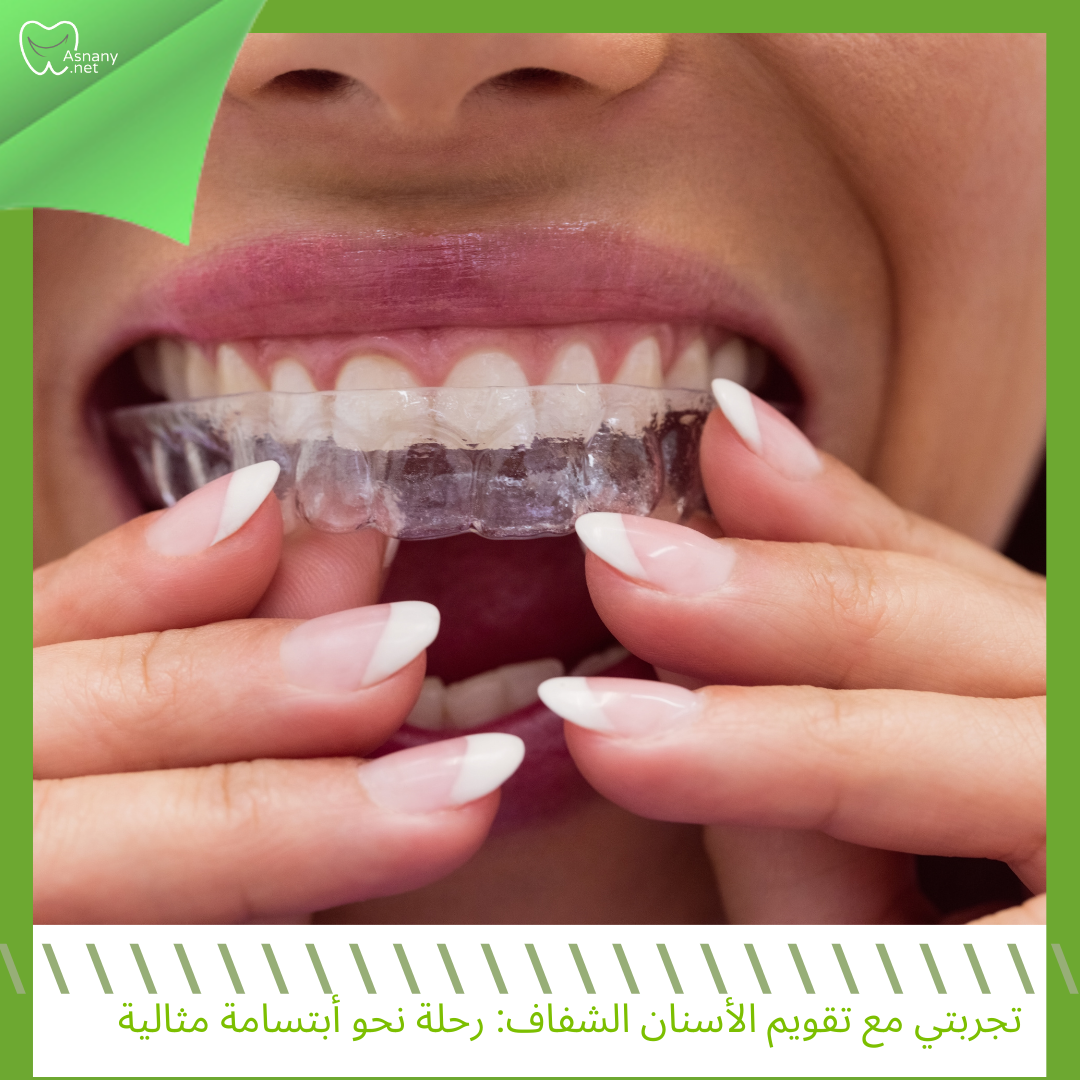 تجربتي مع تقويم الأسنان الشفاف: رحلة نحو ابتسامة مثالية